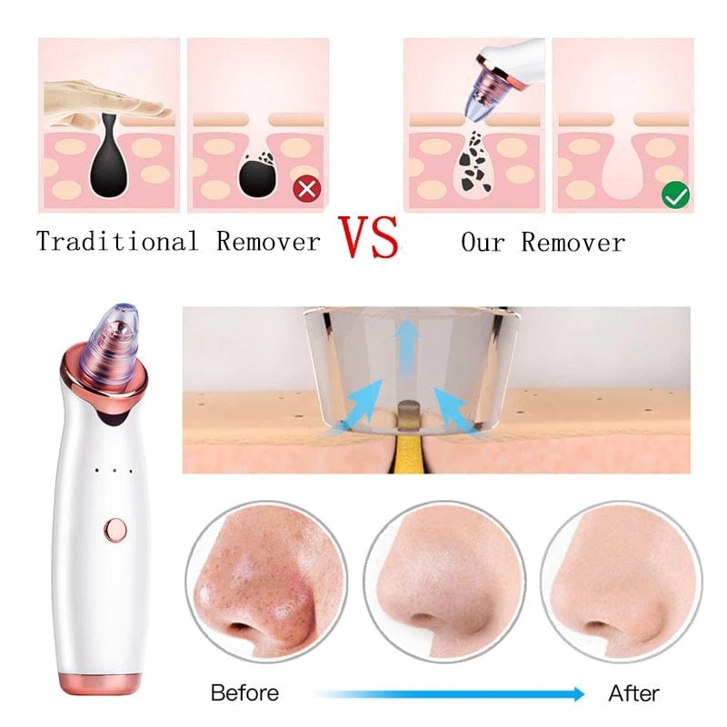 Electric Vacuum Blackhead Remover - PerfectSkin™